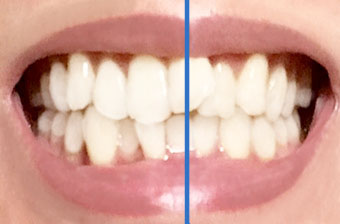 正中線と歯並びのバランス（Median line）