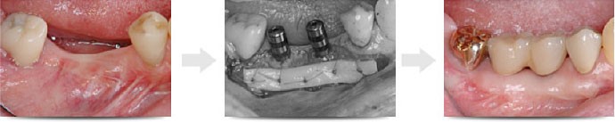 見た目を修復する歯肉移植手術
